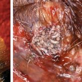 Close up of head-end of screwworm fly larva (maggot) and dense infestation of screwworm fly larvae in open wound 