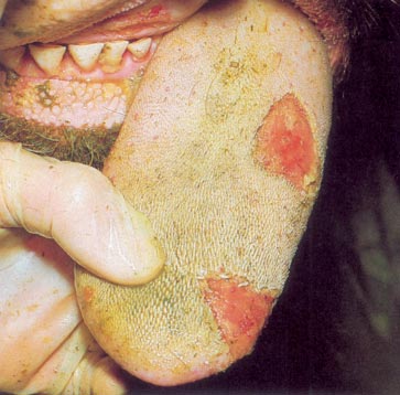 Steer with FMD tongue lesions Steer with FMD tongue lesions